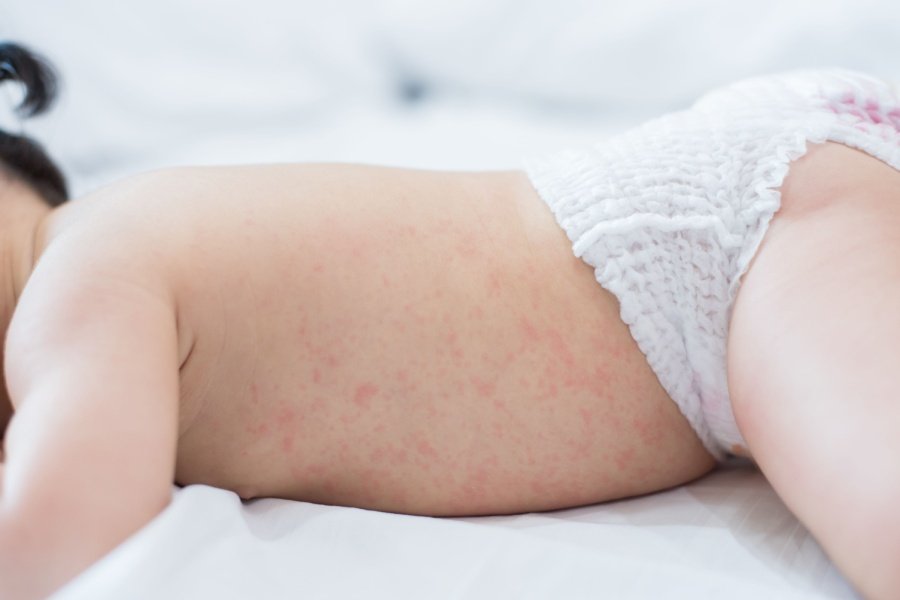 baby rashes