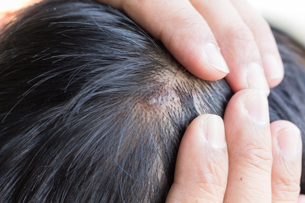 acne on scalp