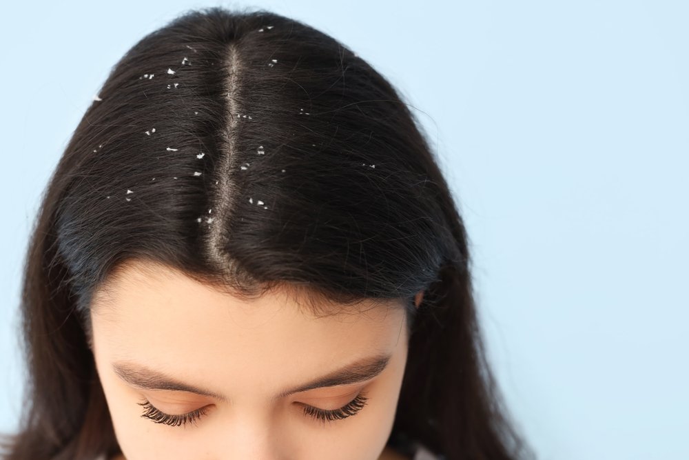 woman with dandruff