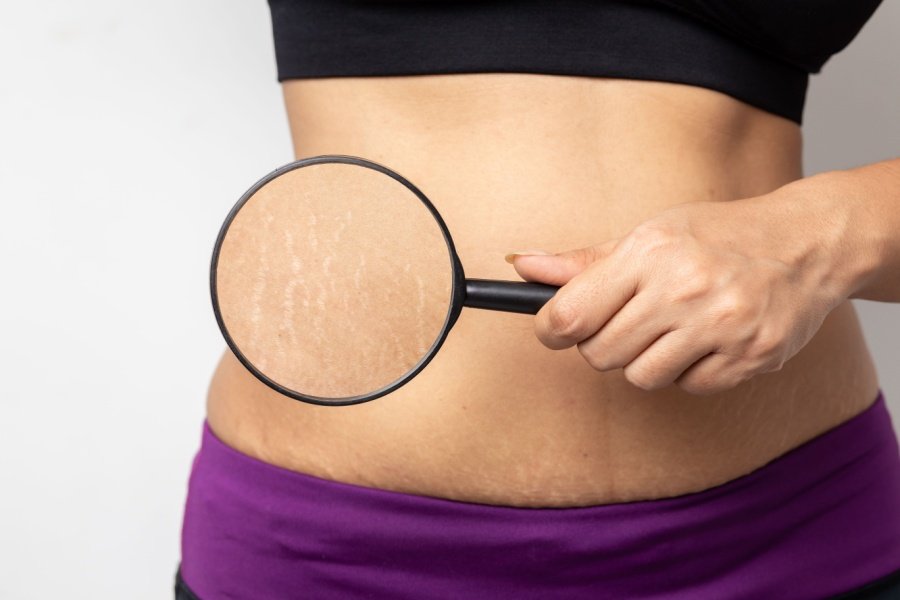 stretchmarks