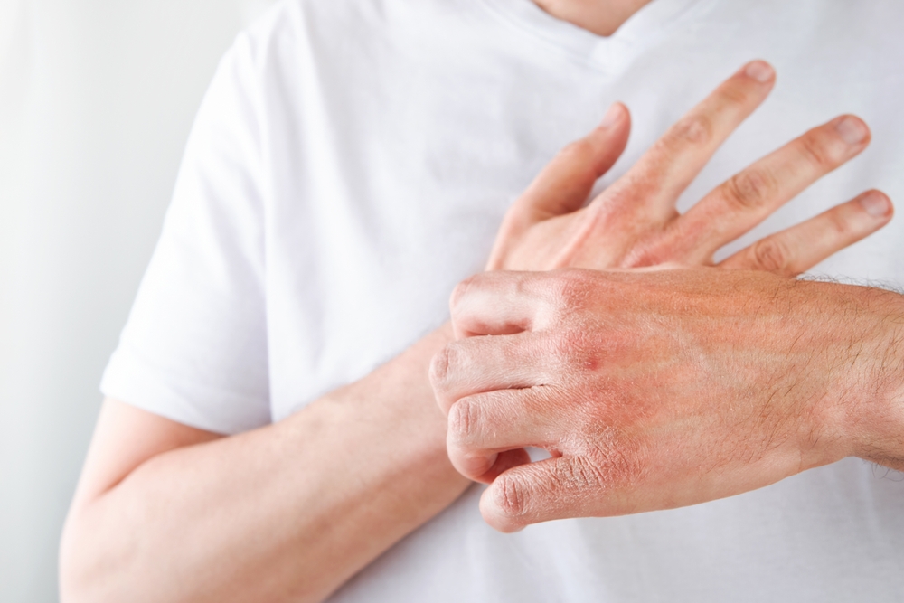 eczema in hands