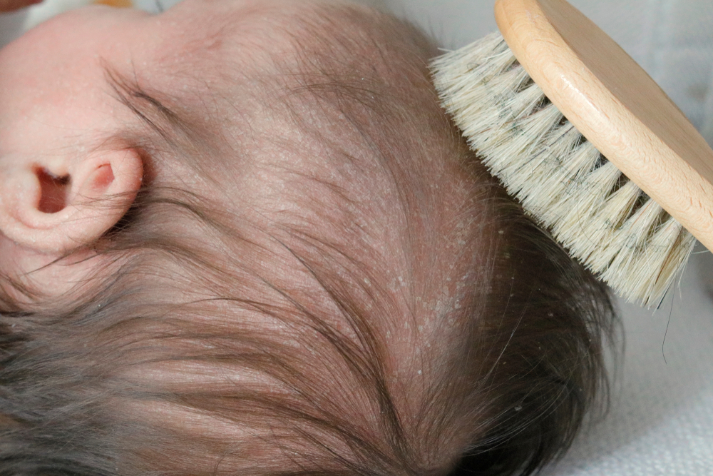 cradle cap in baby