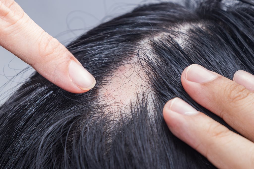 woman with Alopecia Areata