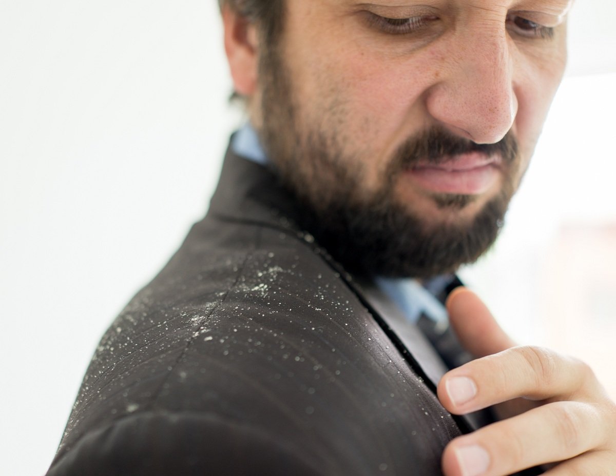 businessman with dandruff