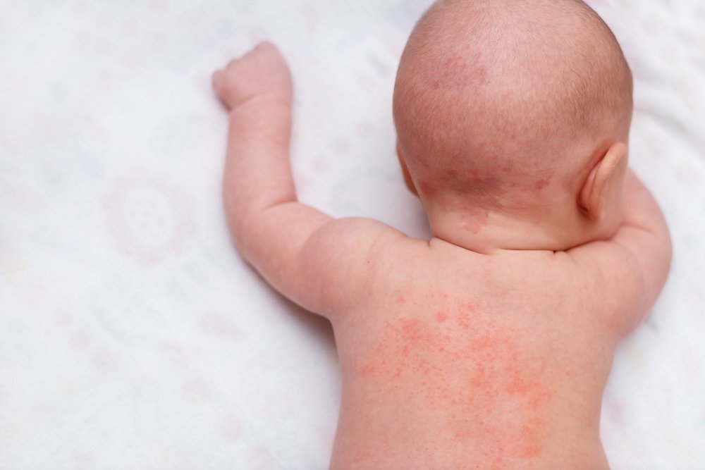prickly heat on babies