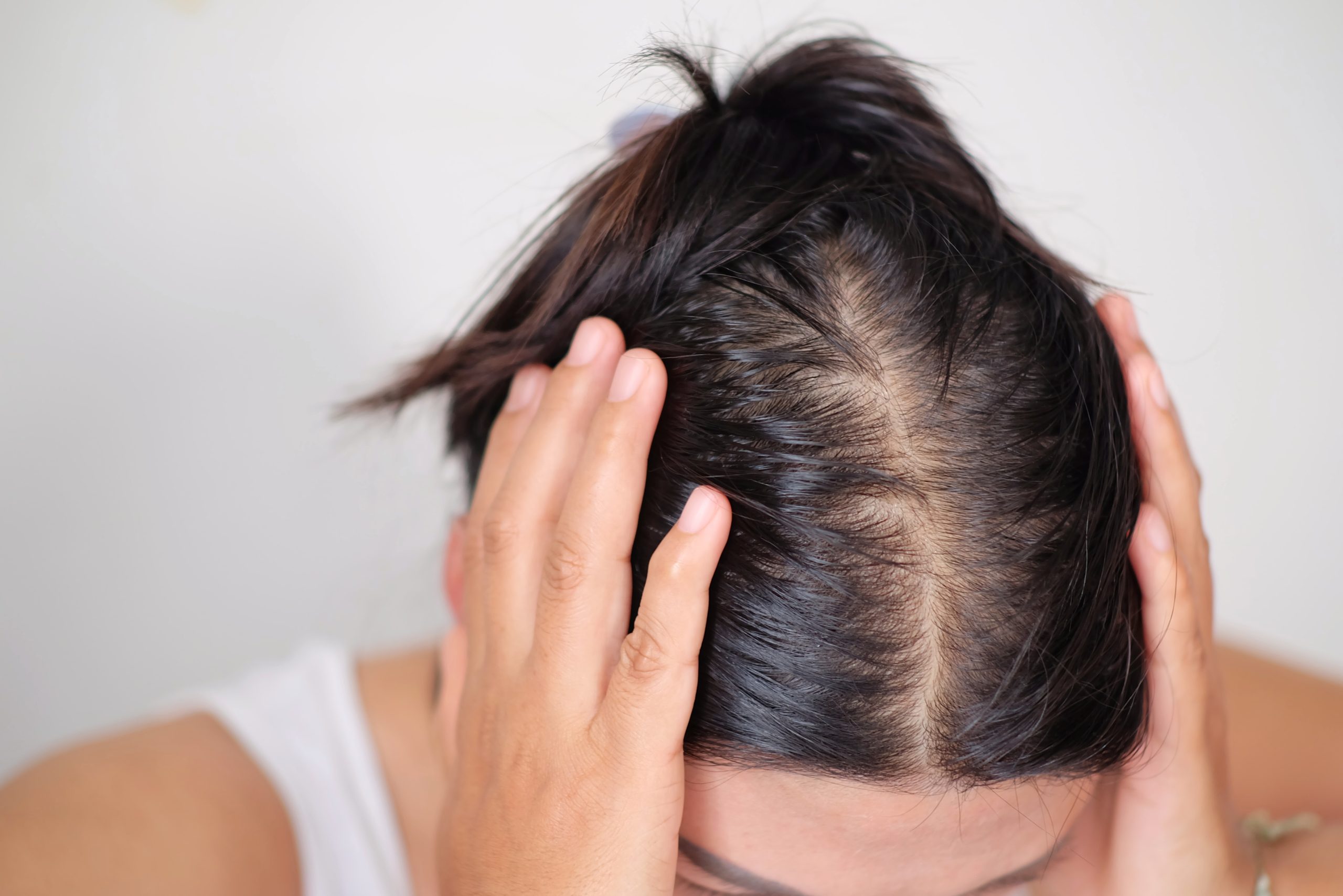 a woman with hair loss