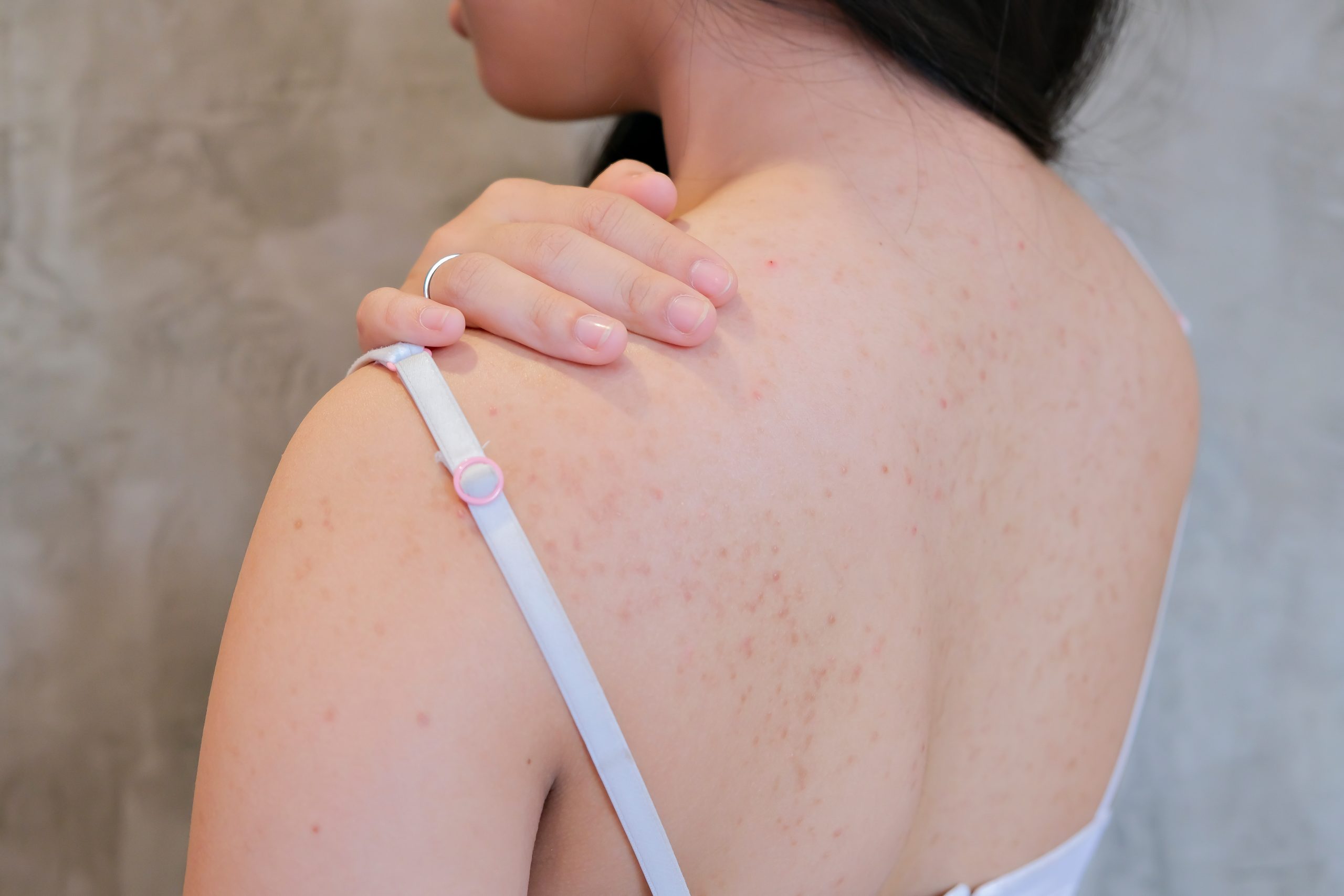 a woman with scarred back