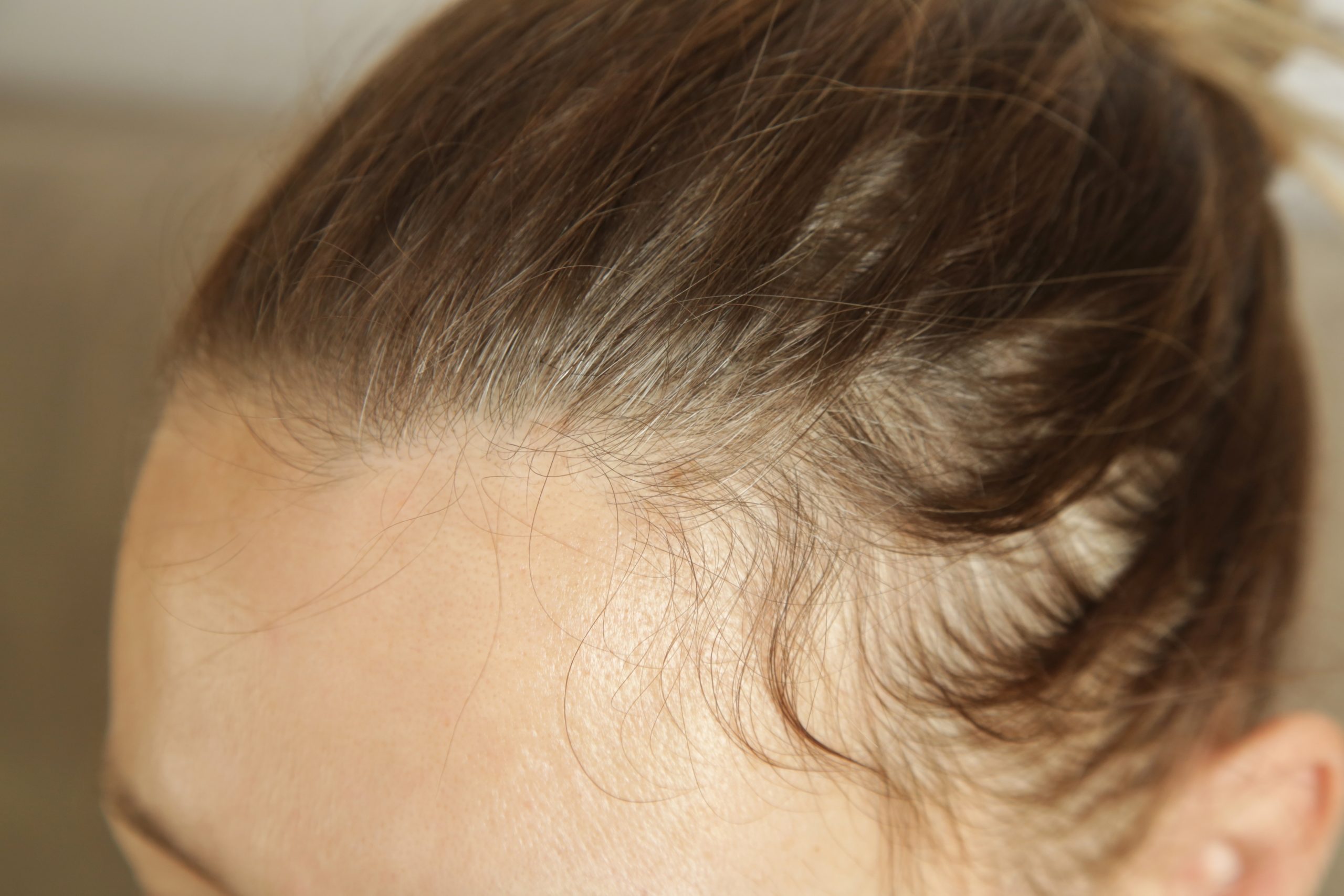 a woman with hair loss
